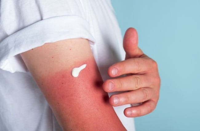 Liburan Seru, Kulit Jadi Gosong? Ini 9 Tips Ampuh Atasi Sunburn