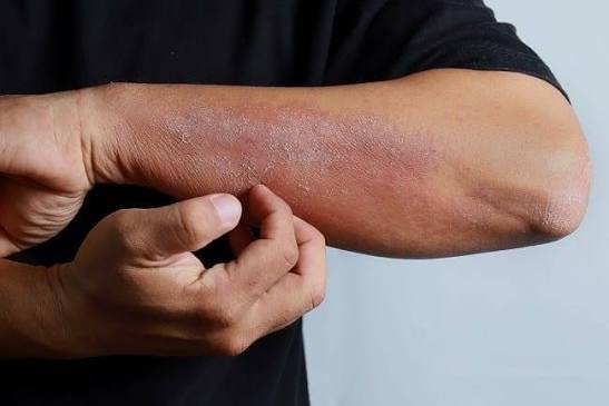 5 Cara Mengatasi Kulit Kering saat Cuaca Panas, Jaga Kelembapan dan Skin Barrier