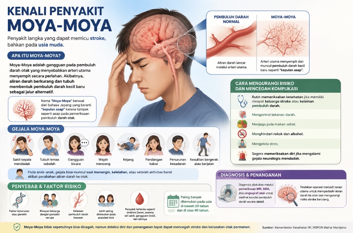 Moya-Moya Bisa Picu Stroke! Kenali Gejala, Penyebab, hingga Cara Mencegah Risikonya