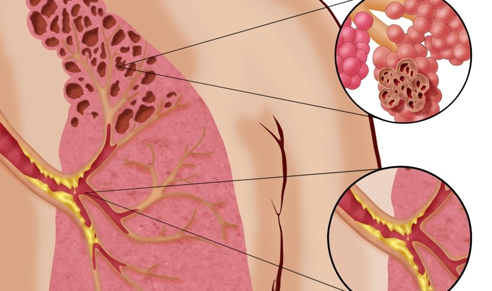 Waspada! Vaping Bisa Hasilkan Popcorn, tapi Popcorn yang Merusak Paru-Paru alias Penyakit Popcorn Lung! 