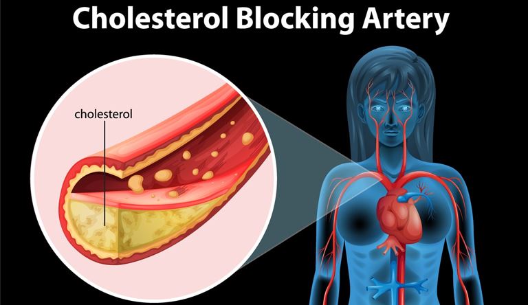 Dokter Temukan Cara Hapus Kolesterol Jahat dari Tubuh Tanpa Obat Seumur Hidup!