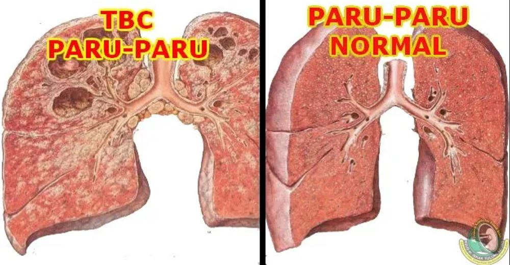 TBC Tembus 134 Ribu dalam Setahun, Menkes: Setara 2 Warga Meninggal Setiap 5 Menit