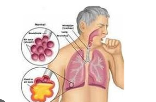 Tuntaskan TBC, Dinkes Kota Batu Gandeng Baznas, agar Kover Uang Nafkah selama Kepala Rumah Tangga Berobat