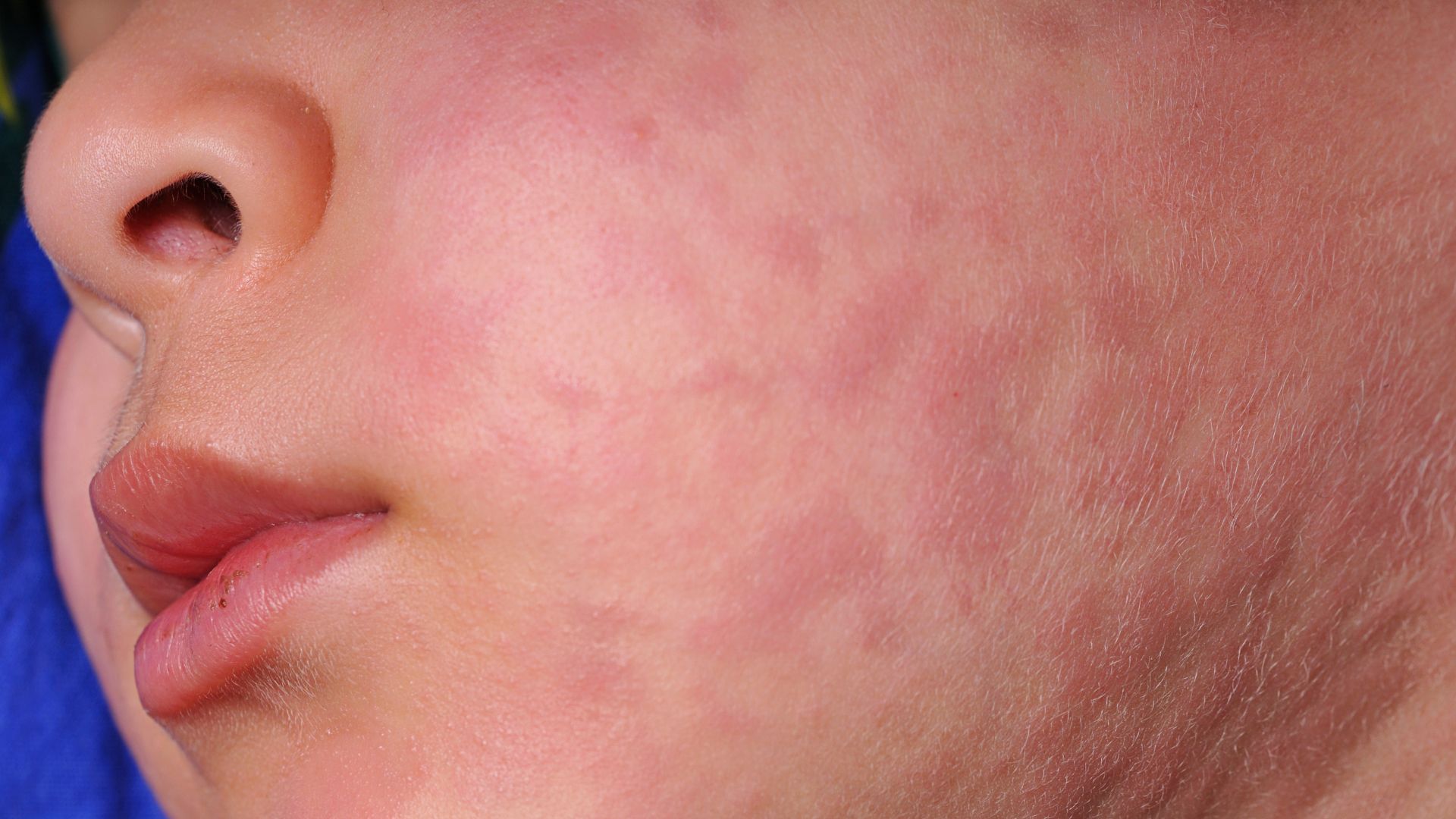 Campak Bisa Diatasi, Ini 9 Cara yang Bisa Dilakukan di Rumah