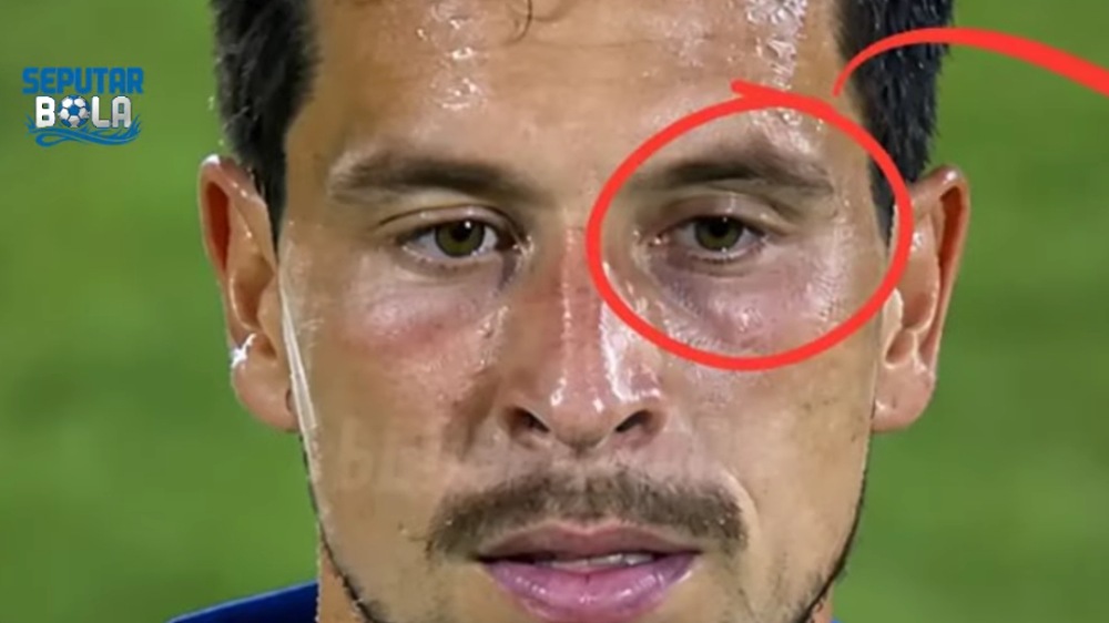 Thom Haye dan Mata Lebam Usai Keributan, Ini yang Sebenarnya Terjadi