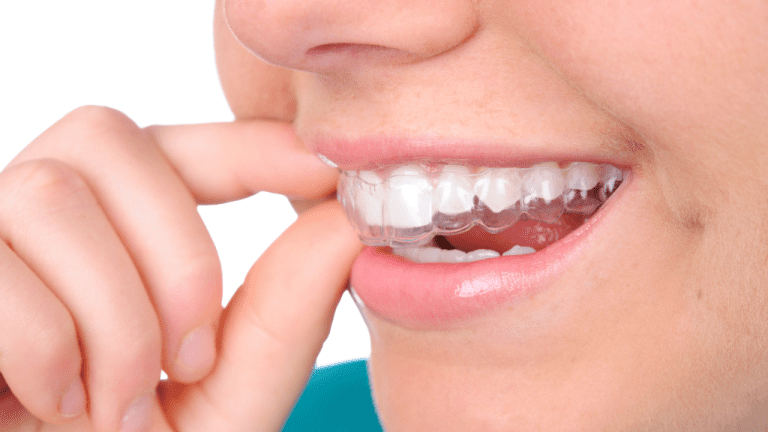 19 Juli Hari Retainer Internasional: Kenali Fungsi dan 9 Tips Penggunaan Retainer Gigi yang Tepat