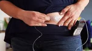 Penderita Diabetes di Indonesia Terus Meningkat, Wamenkes Sodorkan Solusi dengan Teknologi Pankreas Buatan