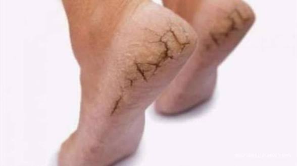 Jangan Diabaikan! Tumit Pecah-Pecah Bisa Makin Parah, Ini Cara Mengatasinya