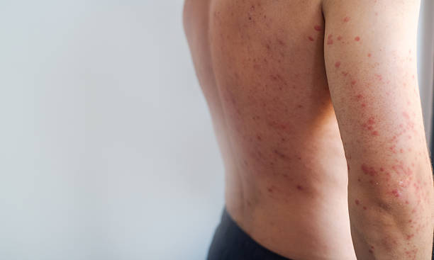 Indonesia Peringkat Kedua Dunia, Kemenkes Ingatkan Kewaspadaan Campak Jelang Mudik Lebaran