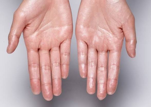 Hyperhidrosis: Penyebab Keringat Berlebih yang Bisa Muncul Meski Tubuh Tidak Kepanasan