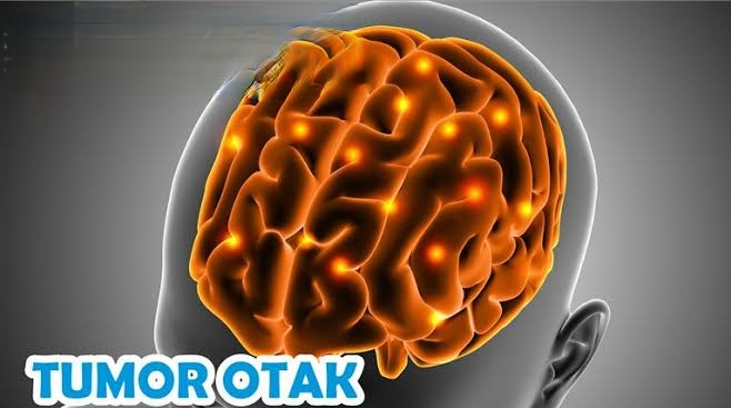 8 Juni Juga Hari Tumor Otak Sedunia, Momen Pengingat Penyakit Penyebab Utama Kematian Remaja Pengidap Kanker 