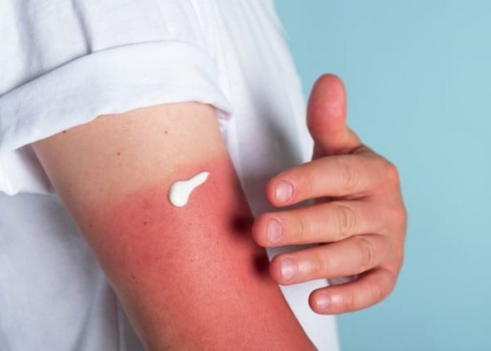 Liburan Seru, Kulit Jadi Gosong? Ini 9 Tips Ampuh Atasi Sunburn