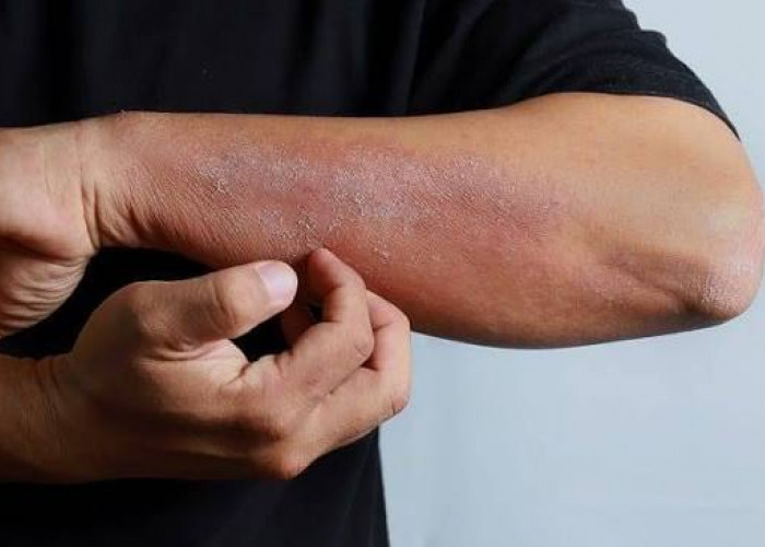 5 Cara Mengatasi Kulit Kering saat Cuaca Panas, Jaga Kelembapan dan Skin Barrier