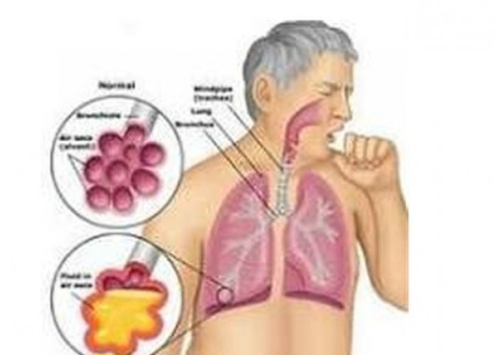 Tuntaskan TBC, Dinkes Kota Batu Gandeng Baznas, agar Kover Uang Nafkah selama Kepala Rumah Tangga Berobat