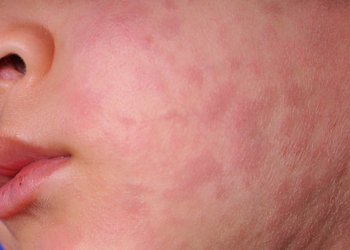 Campak Bisa Diatasi, Ini 9 Cara yang Bisa Dilakukan di Rumah