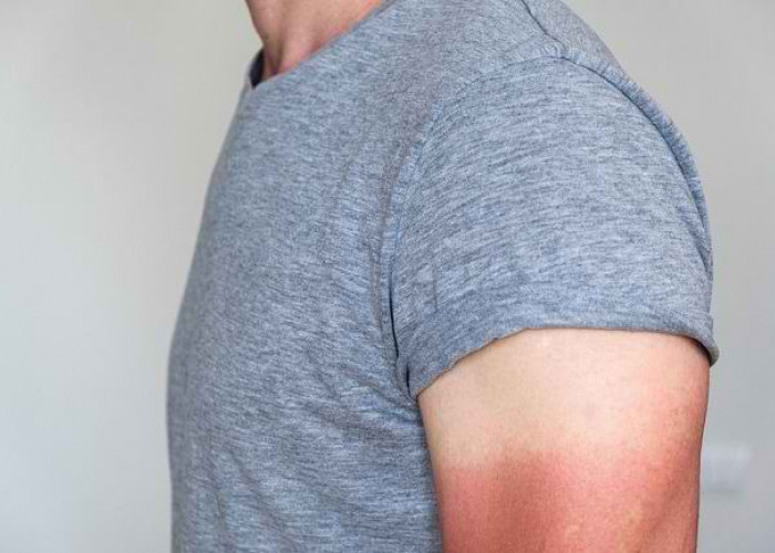 Kulit Belang Bukan Takdir! Kenali Penyebab, Bahaya Tersembunyi, dan Cara Ampuh Mengatasinya