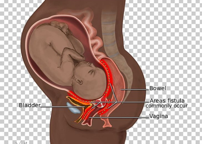 23 Mei Juga Hari untuk Mengakhiri Fistula Obstetrik, Ini Dampak bagi Perempuan Sehingga Perlu Diperingati