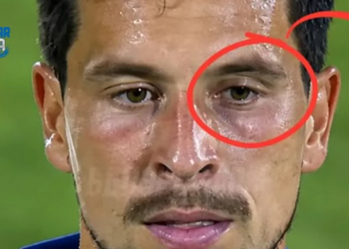 Thom Haye dan Mata Lebam Usai Keributan, Ini yang Sebenarnya Terjadi