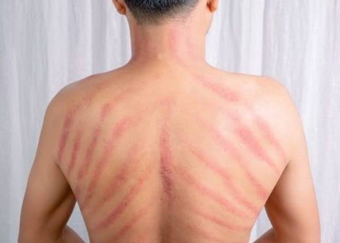 Kerokan Bikin Badan Lega saat Masuk Angin? Ini Penjelasan Medis dan Risikonya