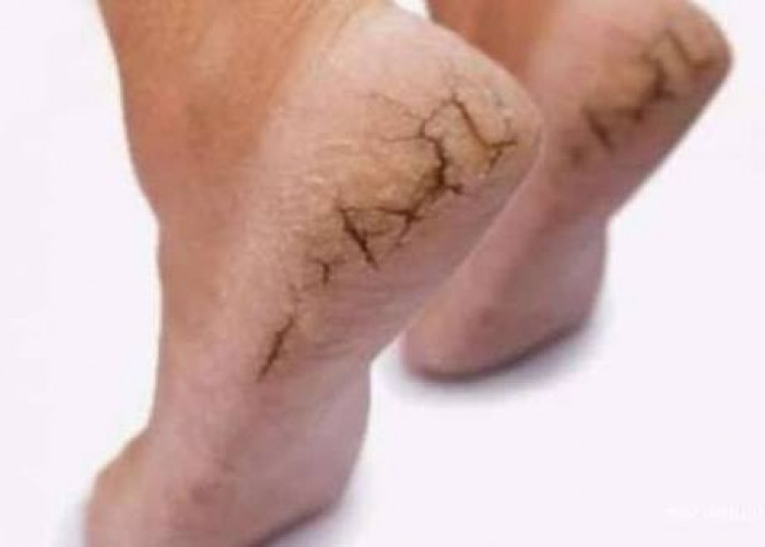 Jangan Diabaikan! Tumit Pecah-Pecah Bisa Makin Parah, Ini Cara Mengatasinya