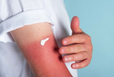 Liburan Seru, Kulit Jadi Gosong? Ini 9 Tips Ampuh Atasi Sunburn
