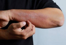 5 Cara Mengatasi Kulit Kering saat Cuaca Panas, Jaga Kelembapan dan Skin Barrier
