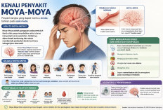 Moya-Moya Bisa Picu Stroke! Kenali Gejala, Penyebab, hingga Cara Mencegah Risikonya