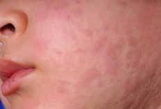 Campak Bisa Diatasi, Ini 9 Cara yang Bisa Dilakukan di Rumah