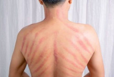 Kerokan Bikin Badan Lega saat Masuk Angin? Ini Penjelasan Medis dan Risikonya