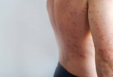 Indonesia Peringkat Kedua Dunia, Kemenkes Ingatkan Kewaspadaan Campak Jelang Mudik Lebaran