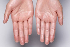 Hyperhidrosis: Penyebab Keringat Berlebih yang Bisa Muncul Meski Tubuh Tidak Kepanasan